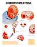 Understanding Stroke